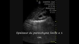 Hydronephrose severe Echographie de poche aux urgences [upl. by Marlene]