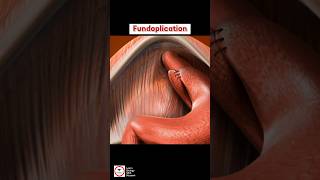 Fundoplication  Surgical Procedure [upl. by Aria]