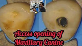 Access opening of Maxillary Canine step by step demonstration rct for beginners rctdentallectures [upl. by Aissatsan214]