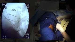 WATCH a Cervical Radiofrequency Ablation  LIVE [upl. by Tam]