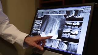 Philadelphia Dentistry  Scaling and Root Planing  Crisp Video [upl. by Ellehsat]