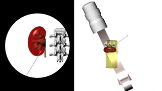 ESUT educational video on fluoroscopic guided puncture in PCNL All techniques step by step [upl. by Dloniger]