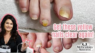 Pedicure Transformation on Yellow Toenails [upl. by Itisahc]