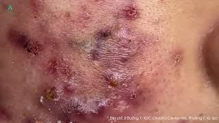 Big Cystic Acne Blackheads Extraction Blackheads amp Milia Whiteheads Removal Pimple Popping [upl. by Jeritah]