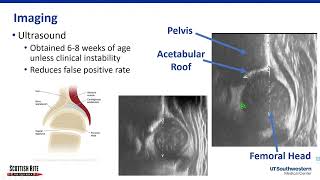 Evaluating for DDH in Newborns [upl. by Marella562]