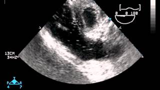 Transesophageal Echocardiography [upl. by Minerva330]