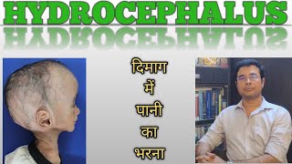 Hydrocephalus A killer disease Hindi  Symptoms amp surgeries  Dr Manish Mishra  Neurosurgeon [upl. by Laenaj]