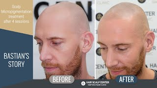 Bastians Scalp Micropigmentation experience at Hair Scalp Center  Bangkok Thailand [upl. by Annekam]