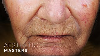 Laser Resurfacing for Deep Wrinkles  CO2 Laser [upl. by Attaynek]