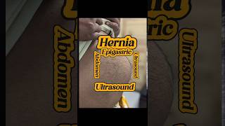 How to Ultrasound Epigaric Hernia  Wall Defect Gap  Hernia  Ultrasound  Surgery  Mesh [upl. by Pelag868]