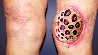 Top 100 Trypophobia Disease Photos Ever NSFE [upl. by Salbu]