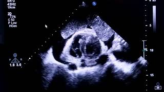 Echocardiogram  significant pericardial effusion with a large intrapericardial mass [upl. by Parsifal]