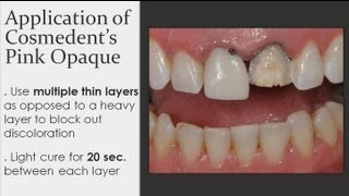 Composite Veneer  Masking Discolored Teeth [upl. by Zebada]