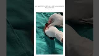 ICD INTERCOSTAL DRAINAGE TUBE INSERTION HOW TO INSERTPUT ICD [upl. by Terence]