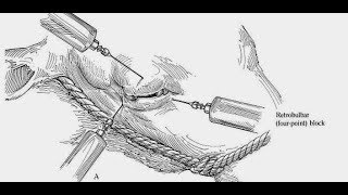 Retrobulbar nerve block in cattle 🐄 🐂 Peterson and four points block 🐄 🐂 [upl. by Liahkim]