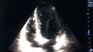 Myocarditis and echocardiographydrahmadmirdamadisiRSay4FU8O1HxWfD9 [upl. by Geminian706]