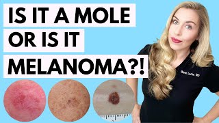 Is It A Mole or Melanoma This Might Save Your Life  Dermatologist Tips [upl. by Eelnayr]