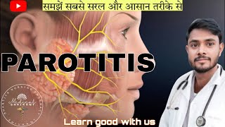 Parotitis  parotitis in hindi  paroted gland swelling  paroted gland or salivary gland infection [upl. by Valeta]