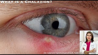 What is a Chalazion quotWhat is that red bump on my eyelidquot [upl. by Boland221]