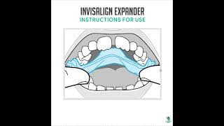 Invisalign Expander  IPE  Instructions for Use [upl. by Prudie514]