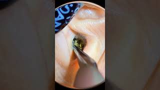 earwax removed every 3 years [upl. by Dric10]