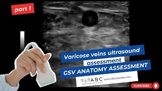 Part 1 Varicose veins ultrasound assessment GSV anatomy assessment [upl. by Ahsatal]