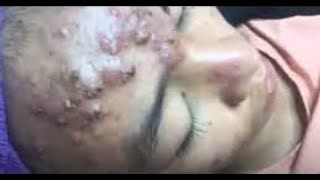 The Most Extreme Blackhead Popping Videos of 2023  satisfying  blackheads  pimple [upl. by Smukler]