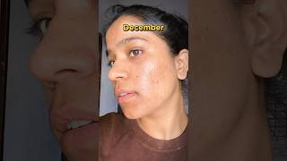 Tretinoin cream before and after  January to December Transformation  tretinoin acne face  🤫 [upl. by Kcor449]