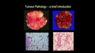 Tumour pathology  a brief introduction part III [upl. by Gordan]