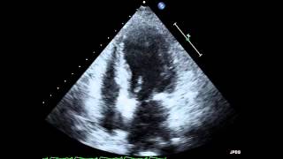 Takotsubo Cardiomyopathy Echocardiogram [upl. by Keeley994]