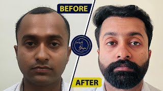 Amazing Hair Transplant Transformation Before and After Results Revealed thehairandshapeclinic [upl. by Obediah]