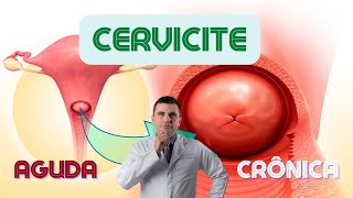 Cervicite Crônica e Aguda [upl. by Merwyn930]