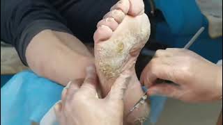 Cracked Heels So satisfying 9 mins Dead skin removal and Cracked heel treatment [upl. by Ahsayn265]