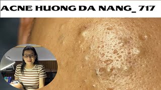 Acne Treatment Huong Da Nang 717  Remove Blackheads [upl. by Atiuqa]