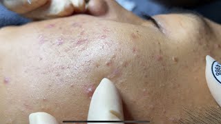 Blackheads amp Whiteheads Removal New 2024  Acne Treatment With Bo Nguyễn Spa 018 [upl. by Bink699]