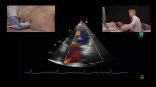 Jet Direction and the Mechanism of Mitral Regurgitation [upl. by Ram]