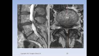 Lumbar Spinal Stenosis Cauda Equina Syndrome Sciatica amp Disc Herniation An Advanced Lecture [upl. by Takashi]