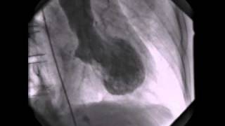 Takotsubo Cardiomyopathy [upl. by Nrehtac]