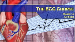 The ECG Course  AV Blocks [upl. by Oek]