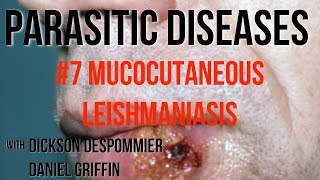 Parasitic Diseases Lectures 7 Mucocutaneous Leishmaniasis [upl. by Sisile]