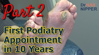 Monster Callus  First Podiatry Appointment in 10 Years Part 2 Callus Tuesday 2023 [upl. by Kcerred]