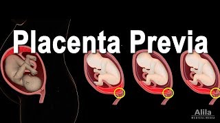 Low Lying Placenta  Placenta Previa Animation [upl. by Anilegnave940]