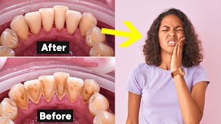 Deep Teeth Cleaning Recovery Tips How To Heal Fast [upl. by Dianna310]