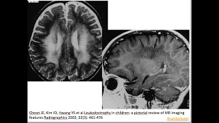 49 Metachromatic leukodystrophy MLD arylsulfatase A deficiency lysosomal tigroid pattern [upl. by Thgiled]