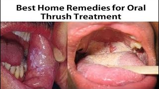 Oral Thrush Symptoms  Home Remedies for Oral Thrush Treatment [upl. by Salta27]