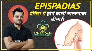 Epispadias in hindi  Epispadias  causes  symptoms  Diagnosis treatment  Chandan Mlt  RanKplus [upl. by Gianni639]