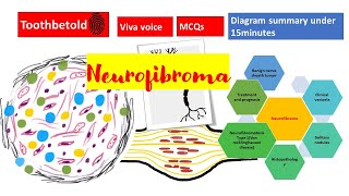 Neurofibroma  Neurofibromatosis Oral pathology  Benign tumors of connective tissue origin [upl. by Wiggins]