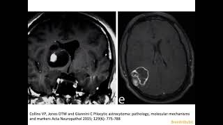 60 Pilocytic astrocytoma brain tumor paediatric astrocyte GFAP optic glioma NF1 pilomyxoid [upl. by Norym989]