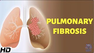 Pulmonary Fibrosis Everything You Need To Know [upl. by Romo]