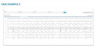 EEG Atlas B4 Realworld EEG Cases Using The Ceribell Rapid Response System [upl. by Ellinej]